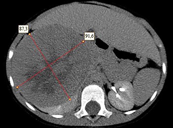 Нефробластомы у детей: что необходимо знать
Нефробластомы у детей: что необходимо знать