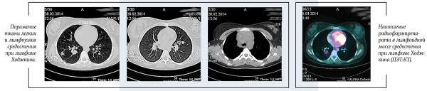 Лимфома Ходжкина у детей и подростков
Лимфома Ходжкина у детей и подростков