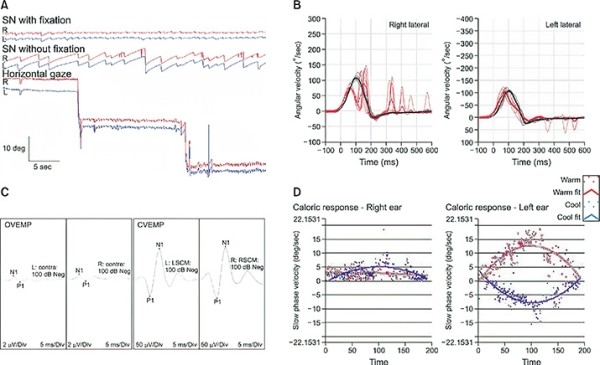 Периферический вестибулярный синдром
Периферический вестибулярный синдром