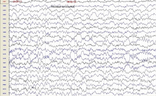 Пароксизмальные состояния у детей неэпилептического характера
Пароксизмальные состояния у детей неэпилептического характера