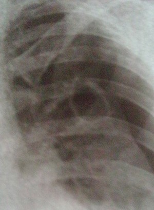 О терапии деструктивных форм туберкулеза легких
О терапии деструктивных форм туберкулеза легких