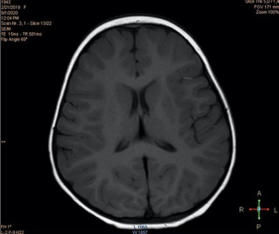 Пароксизмальные состояния у детей неэпилептического характера
Пароксизмальные состояния у детей неэпилептического характера