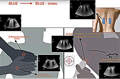 УЗИ легких у пациентов с CoViD-19: характерные признаки поражения и их клиническая значимость. Часть 2
УЗИ легких у пациентов с CoViD-19: характерные признаки поражения и их клиническая значимость. Часть 2