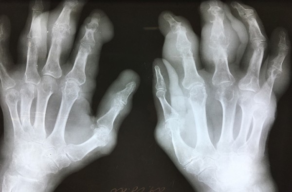 В капкане подагры
В капкане подагры