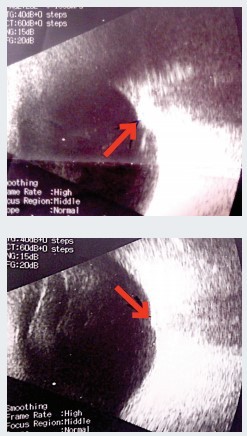 Аденома гипофиза и хиазмальный синдром. Часть 2. Методы лечения
Аденома гипофиза и хиазмальный синдром. Часть 2. Методы лечения
