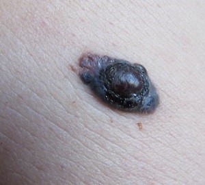 О важности ранней диагностики меланомы кожи
О важности ранней диагностики меланомы кожи