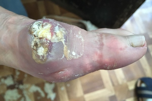 В капкане подагры
В капкане подагры