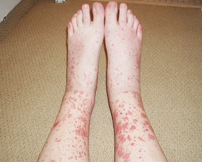 Дерматологические осложнения COVID-19 и тактика ведения пациентов с заболеваниями кожи
Дерматологические осложнения COVID-19 и тактика ведения пациентов с заболеваниями кожи