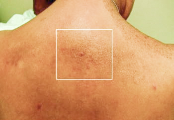 
			Онкоэндокринология: синдром множественной эндокринной неоплазии 2А типа		