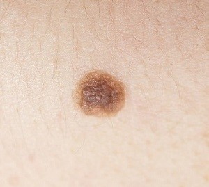 О важности ранней диагностики меланомы кожи
О важности ранней диагностики меланомы кожи