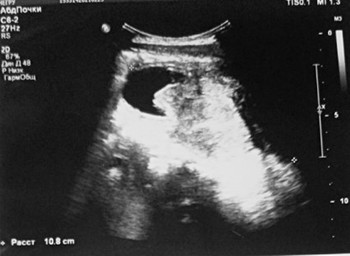 
			Нейрогенный мочевой пузырь		