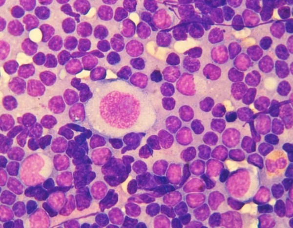 Лимфома Ходжкина у детей и подростков
Лимфома Ходжкина у детей и подростков