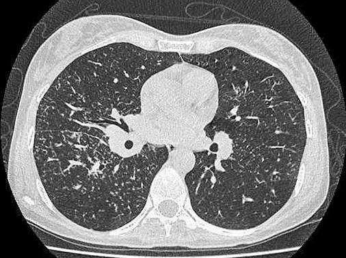 Саркоидоз: нерешенные задачи
Саркоидоз: нерешенные задачи