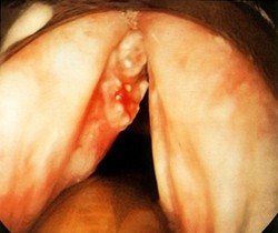 Предраковые заболевания гортани
Предраковые заболевания гортани