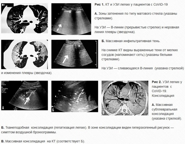 УЗИ легких у пациентов с CoViD-19: опыт китайских специалистов. Часть 1
УЗИ легких у пациентов с CoViD-19: опыт китайских специалистов. Часть 1