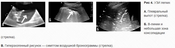 УЗИ легких у пациентов с CoViD-19: опыт китайских специалистов. Часть 1
УЗИ легких у пациентов с CoViD-19: опыт китайских специалистов. Часть 1