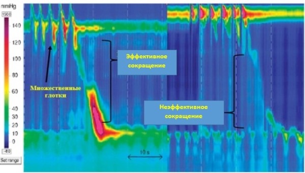 
			Манометрия пищевода высокого разрешения		