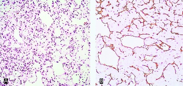 Опухоль в сердце: сложности диагностики и хирургии
Опухоль в сердце: сложности диагностики и хирургии