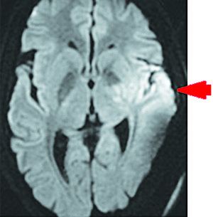 
			Острый ишемический инсульт у подростка: опыт комбинированного внутрисосудистого тромболизиса		