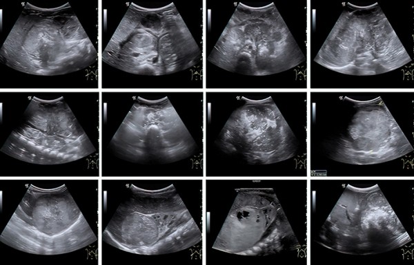 Нейробластома у детей: пути снижения запущенных случаев
Нейробластома у детей: пути снижения запущенных случаев