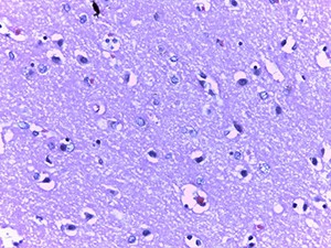 Патоморфологические изменения головного мозга при COVID-19
Патоморфологические изменения головного мозга при COVID-19