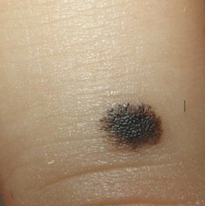 О важности ранней диагностики меланомы кожи
О важности ранней диагностики меланомы кожи