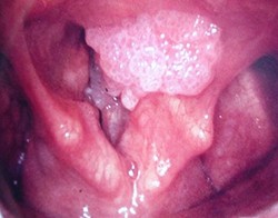 Предраковые заболевания гортани +аудио
Предраковые заболевания гортани +аудио