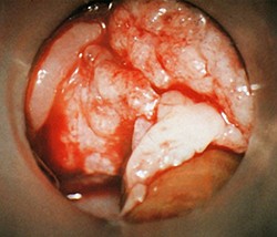 Предраковые заболевания гортани +аудио
Предраковые заболевания гортани +аудио