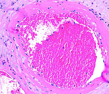 Патология плаценты при COVID-19
Патология плаценты при COVID-19