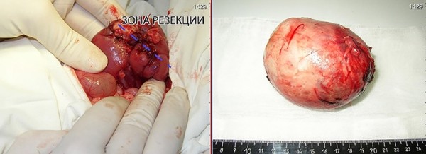 
        Нефробластомы у детей: что необходимо знать			    