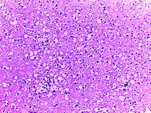 Патоморфологические изменения головного мозга при COVID-19
Патоморфологические изменения головного мозга при COVID-19