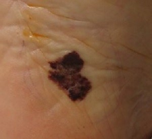 О важности ранней диагностики меланомы кожи
О важности ранней диагностики меланомы кожи