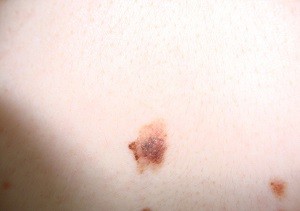 О важности ранней диагностики меланомы кожи
О важности ранней диагностики меланомы кожи