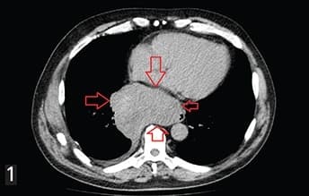 
        Гастроинтестинальные стромальные опухоли: взгляд рентгенолога			    