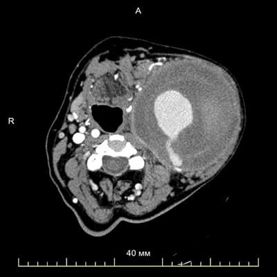 Специалистами отделения сосудистой хирургии Гродненской университетской клиники проведена уникальная операция по удалению аневризмы сонной артерии
Специалистами отделения сосудистой хирургии Гродненской университетской клиники проведена уникальная операция по удалению аневризмы сонной артерии