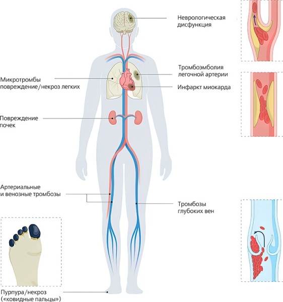 
        Исследование COVID-19-ассоциированной коагулопатии: что известно и что предстоит узнать?			    