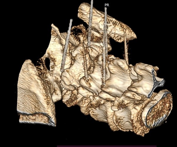 
        Фасеточный синдром: радиочастотная денервация фасеточных суставов			    