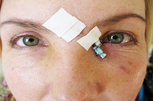 Лечение слезотечения. Часть 2
Лечение слезотечения. Часть 2