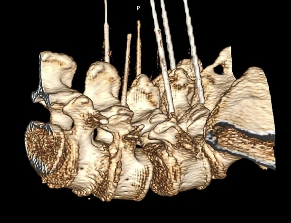 
        Фасеточный синдром: радиочастотная денервация фасеточных суставов			    