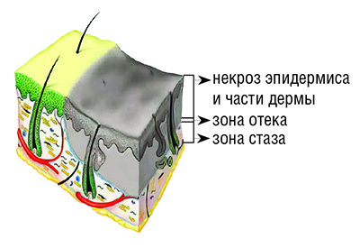 Ожоги: принципы диагностики и выбор тактики лечения. Часть 1
Ожоги: принципы диагностики и выбор тактики лечения. Часть 1