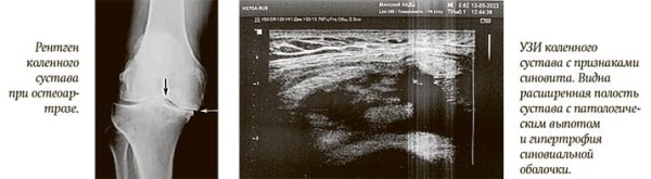 
        Патология суставов: кого направить на Ультразвук			    