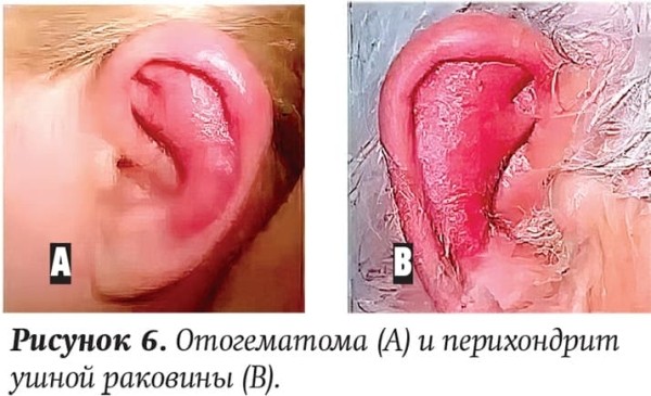 
        Ребенок с лор-патологией на приеме у ВОП и педиатра			    