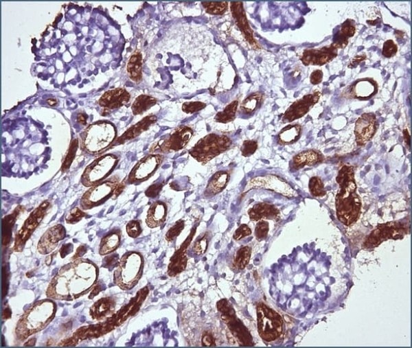 Морфологическая диагностика в детской нефрологии
Морфологическая диагностика в детской нефрологии