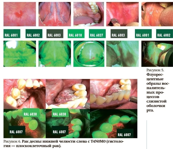 
        Ранняя диагностика патологических состояний слизистой оболочки рта                    