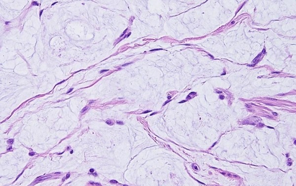 
        Миксома сердца. Случай из практики                     