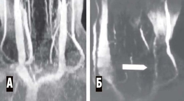 
        Венозная энцефалопатия: постановка диагноза, подходы к лечению                    