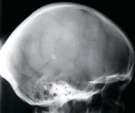 
        Венозная энцефалопатия: постановка диагноза, подходы к лечению                    