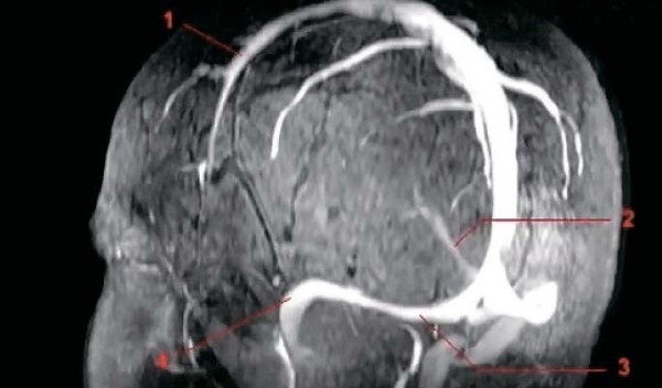
        Венозная энцефалопатия: постановка диагноза, подходы к лечению                    