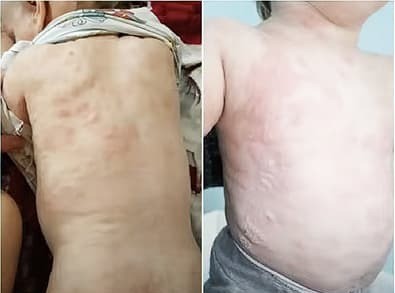 
        Синдром активации тучных клеток. Почему не всегда возможно добиться контроля течения аллергических заболеваний?                    