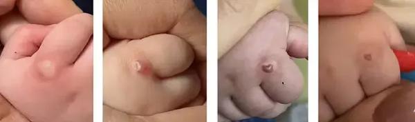 
        Синдром активации тучных клеток. Почему не всегда возможно добиться контроля течения аллергических заболеваний?                    